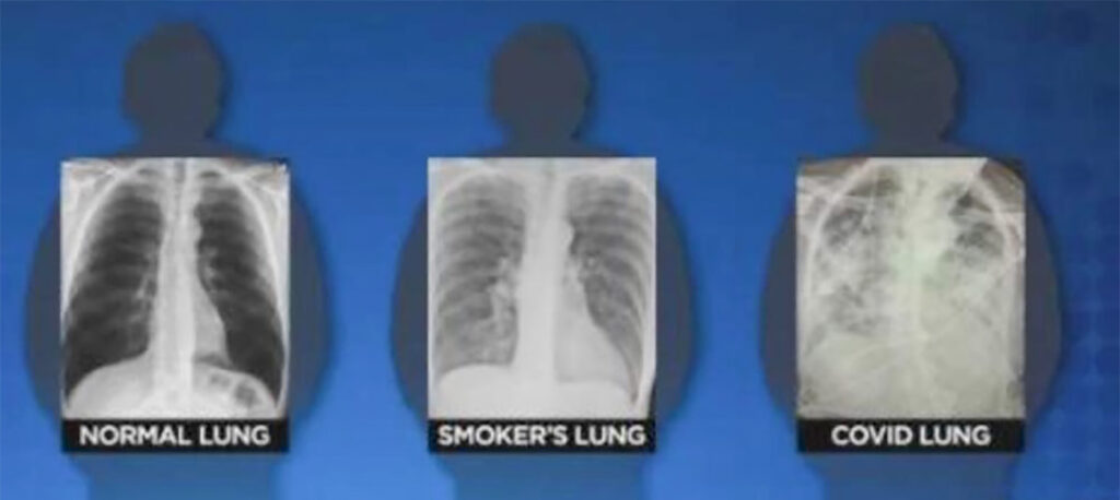 Arsti karm hinnang koroona läbipõdemise kohta: kopsud hullemas olukorras kui ühelgi suitsetajal