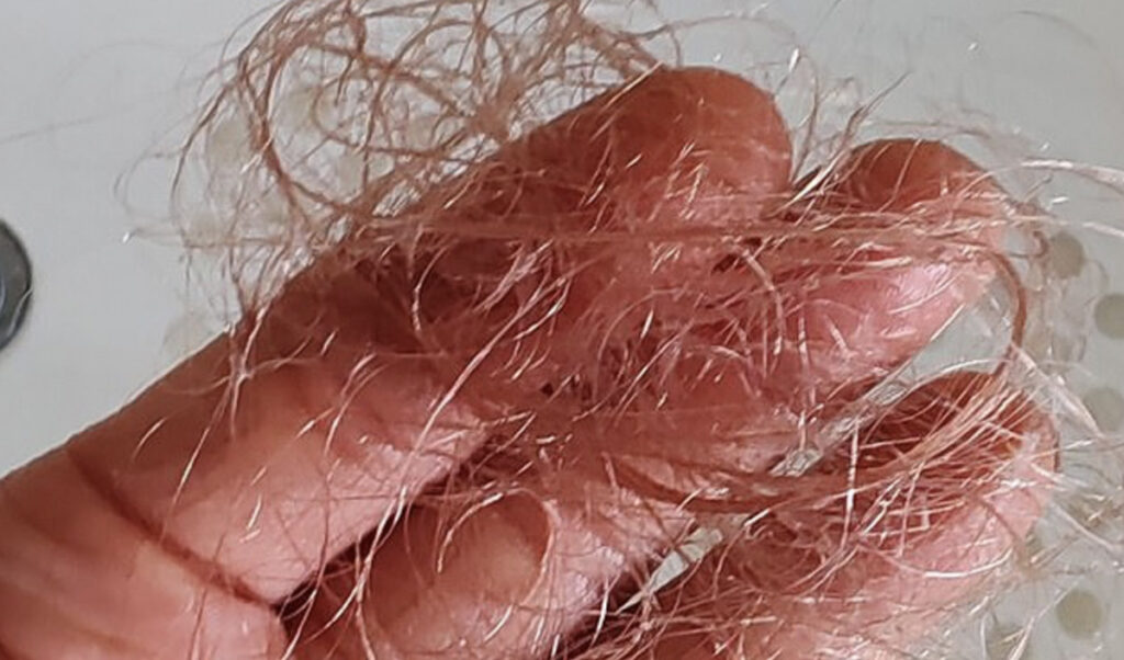 Naine rääkis, kuidas hakkas kiilanema, kui võttis kaalu alandavaid ravimeid