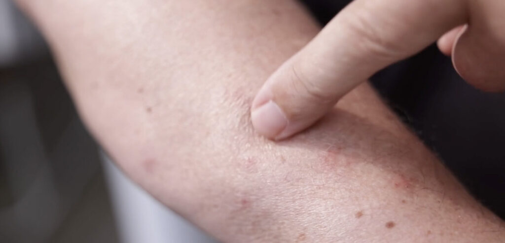 Soomes vohavad lutikad – olukord on muutunud väljakannatamatuks